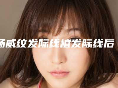杨威纹发际线植发际线后护理5要点